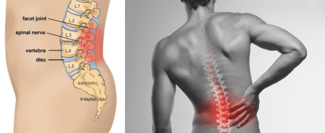 Low Back Pain: Spinal Cord Stimulators - Delaware Pain Management