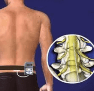 spinal cord stimulator